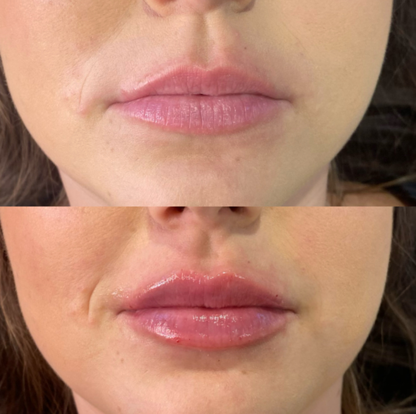 lips B&A.jpeg 2.jpeg