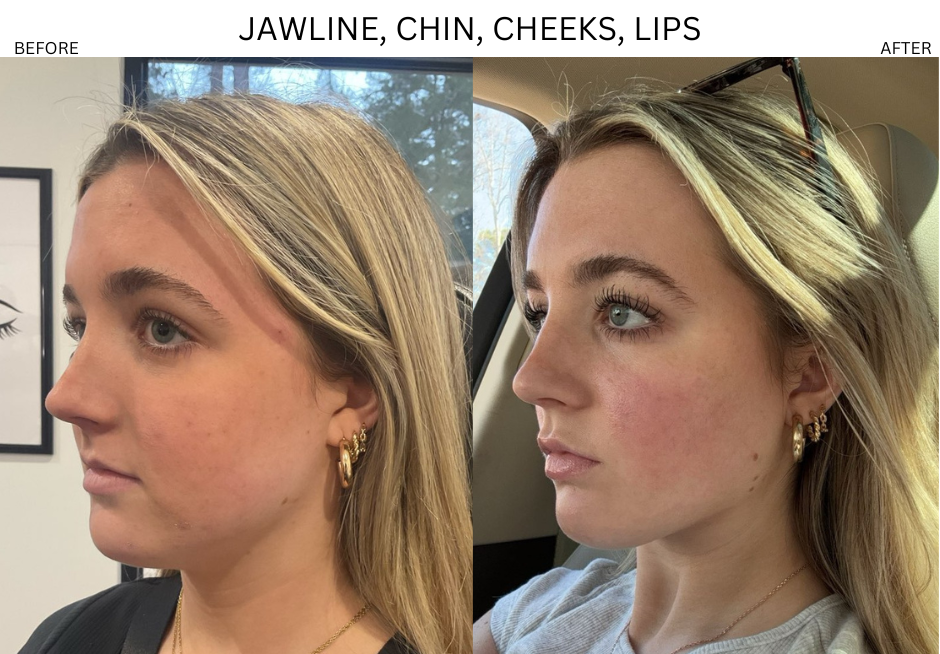 JAWLINE, CHIN, CHEEKS, LIPS.png